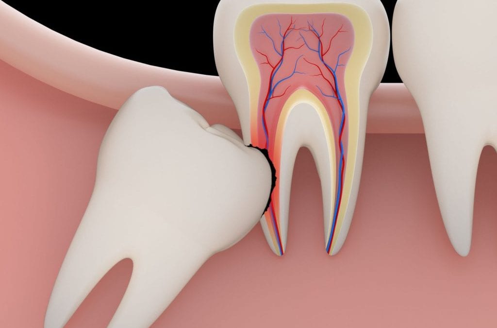 Wisdom tooth removal Singapore Easier and safer